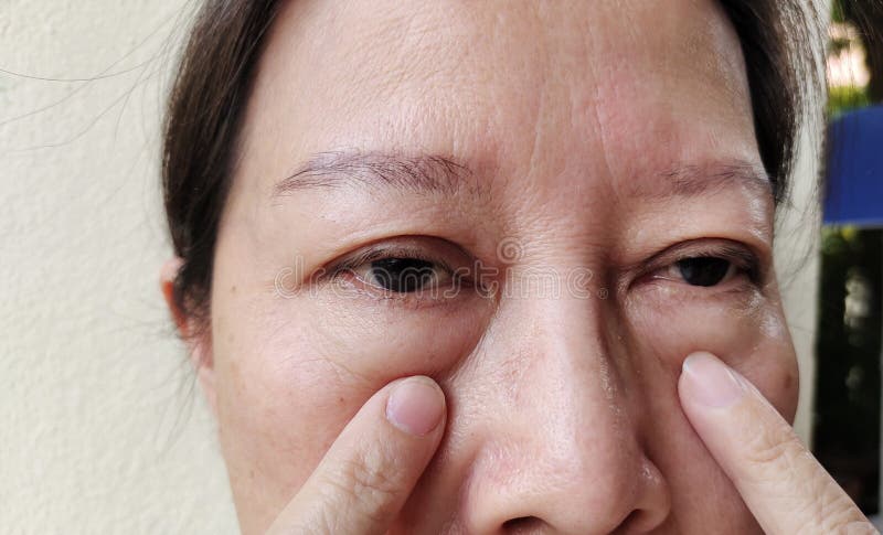Portrait showing the flabbiness adipose sagging under the eyes, ptosis and swelling beside the eyelids, forehead lines and freckles on the face, cellulite and bag under the eyes, problem wrinkle and dullness of the woman, health care and beauty concept. Problem wrinkle stock images, royalty-free photos and pictures