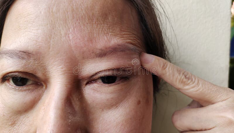 Portrait the flabbiness adipose sagging under the eyes, ptosis beside the eyelids, forehead lines and freckles on the face, cellulite and bag under the eyes, problem wrinkle and dullness of the woman, health care and beauty concept. Problem wrinkle stock images, royalty-free photos and pictures