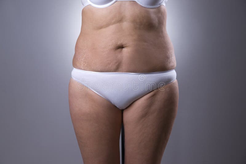 Stretch Marks on a Large Natural Breasts, Obese Woman with Big Boobs, Overweight  Female Body, before and after Concept Stock Image - Image of beauty, chest:  119867327