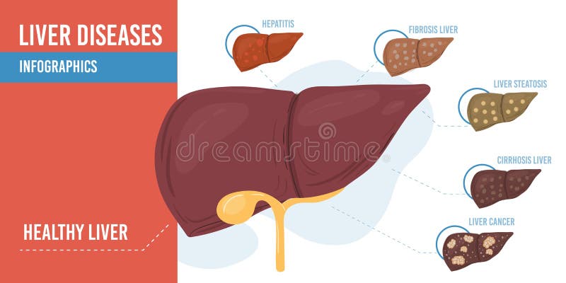 Flat Cartoon Infographic Liver Diseases Vector Illustration Concept