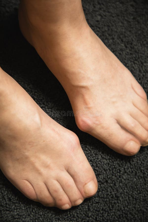Flat Feet and Foot Toe Problems, What Problems Can Flat Feet Cause Stock Image Image of doctor