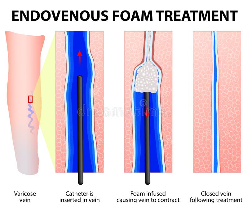 Foam Sclerotherapy. Sclerofoam