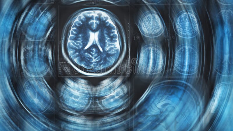 Fond de balayage de cerveau de Mri, tomographie, avec l'effet de mouvement de cercle de tache floue photos stock Fond de balayage de cerveau de Mri, tomographie, avec l'effet de mouvement de cercle de tache floue photos stock