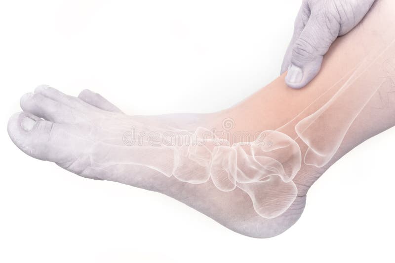 Foot bones injury stock image. Image of calcium, chronic 77122807