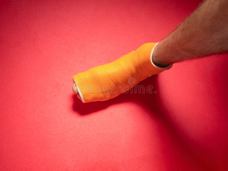 Hand in Cast on White Background Stock Image - Image of fiberglass