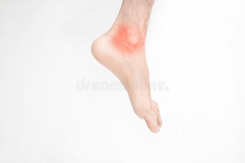 Foot with a Burning Red Sore Ankle on a White Background Stock Image