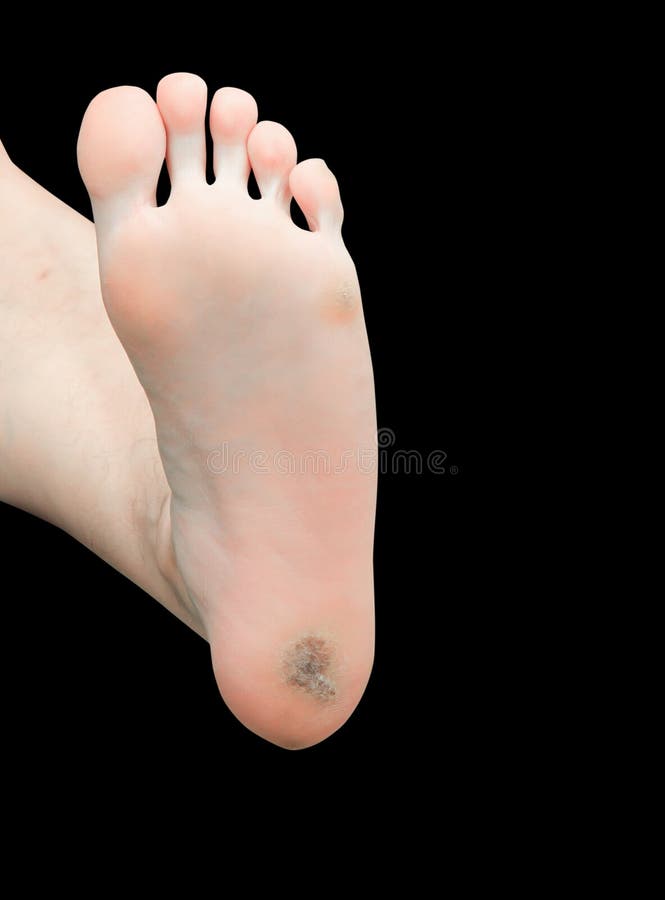 corn on foot with black center