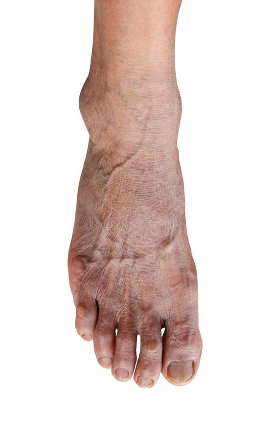 Foot of an Elderly Man with Painful Brittle Nails on the Summer Sand