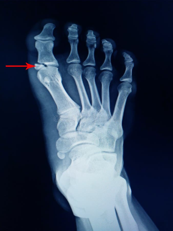 Frattura Dito Piede Risarcimento Assicurazione Foot Fracture Proximal Phalang Stock Image - Image of joint, morphology