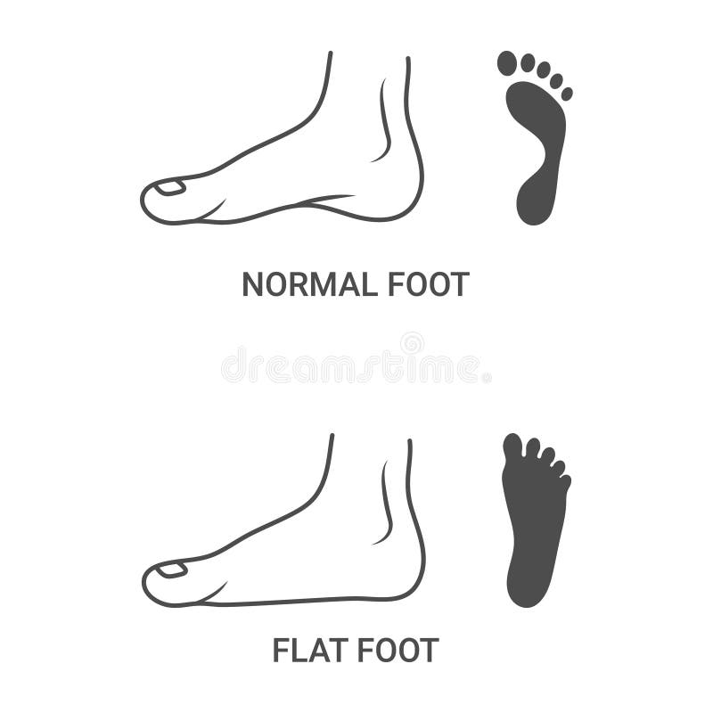 Foot Pathologies, Normal, Flat Foot Isolated On A White Background. Vector Illustration. royalty free illustration