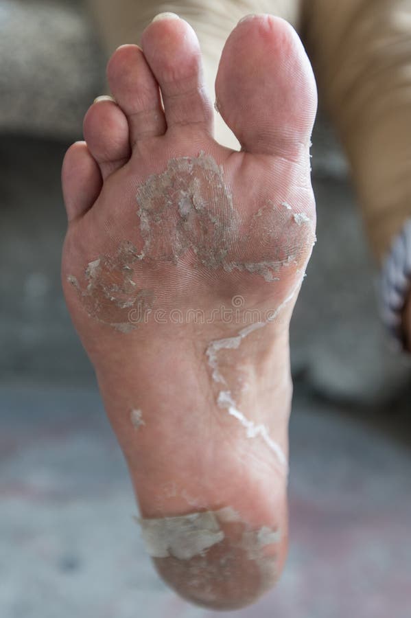 wet foot peeler wet foot peeler