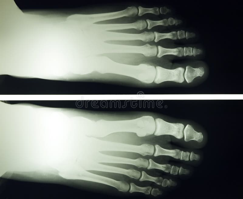 Foot x ray stock image. Image of physical, life, medical 1369521