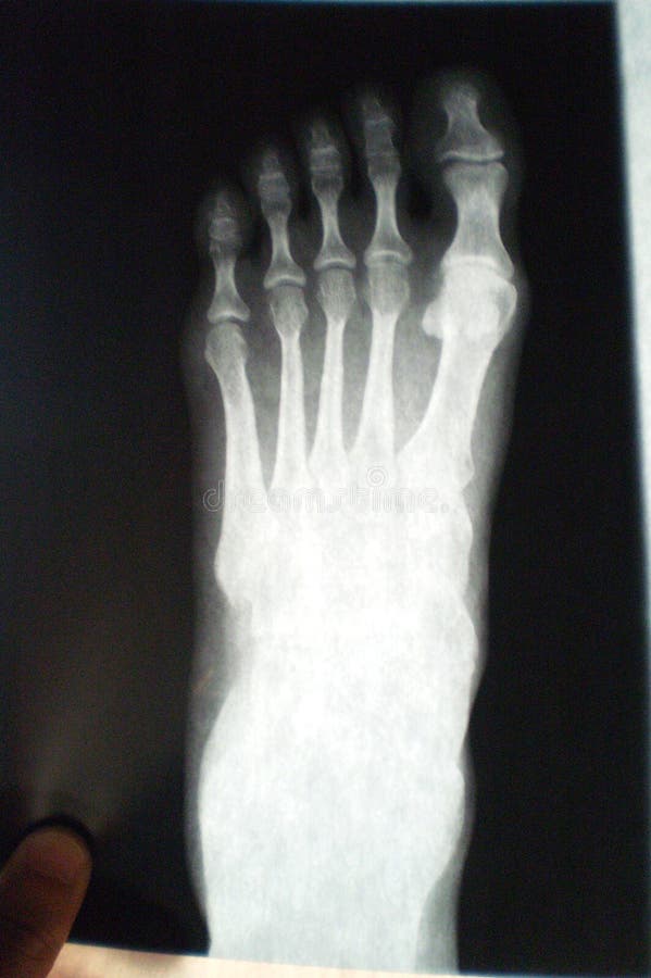 Foot X ray stock image. Image of diagnosis, hospital 14980709