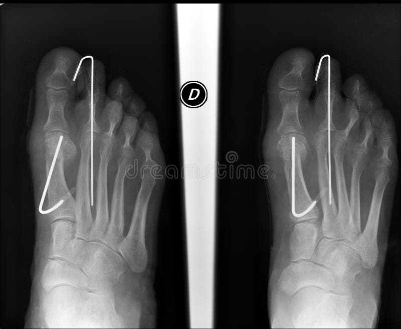 Foot XRay stock image. Image of finger, radiography 18701677