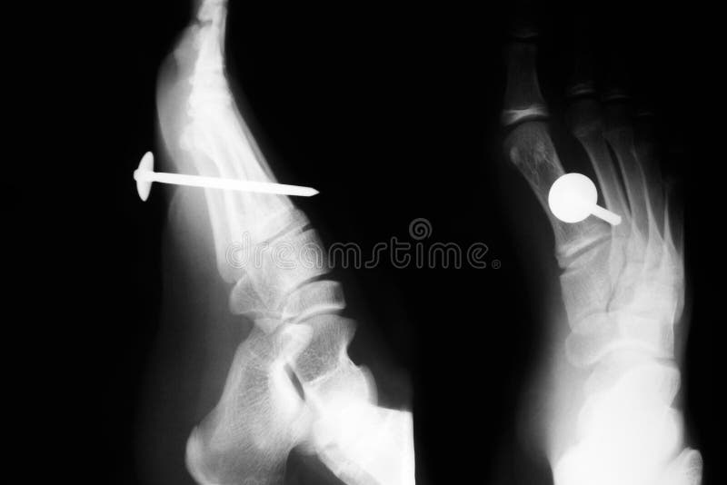 Nail Xray Stock Photos Free & RoyaltyFree Stock Photos from Dreamstime