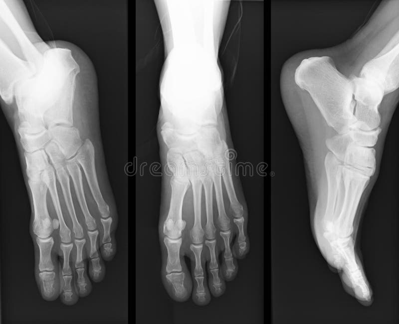 Foot xray stock image. Image of display, medic, inside 5925395