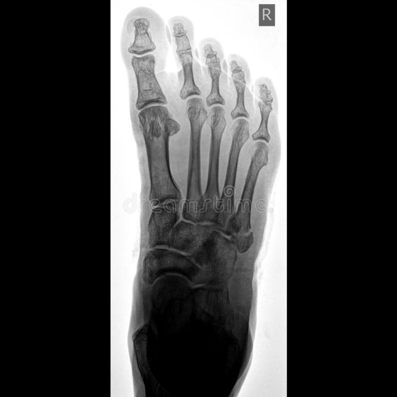 Foot Xray Image Ap View on Isolated White Background Stock Photo
