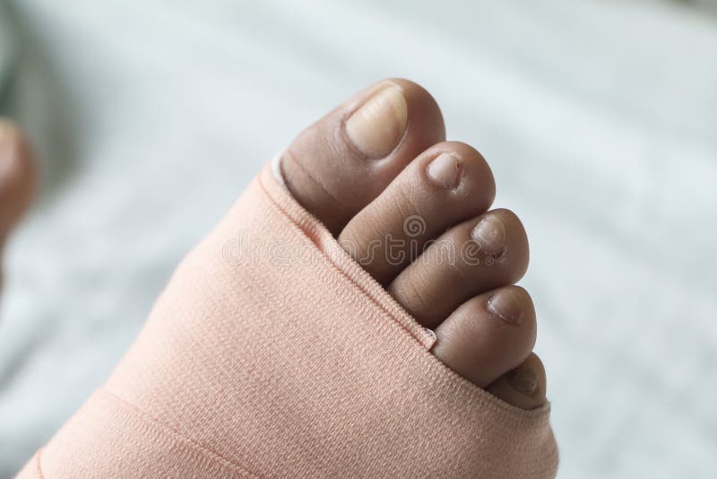 Soft Foot Cast Stock Photos Free & RoyaltyFree Stock Photos from Dreamstime