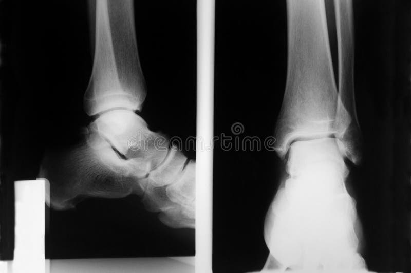 Foot Xray Showing Soft Tissue Gas in Patient with Necrotizing