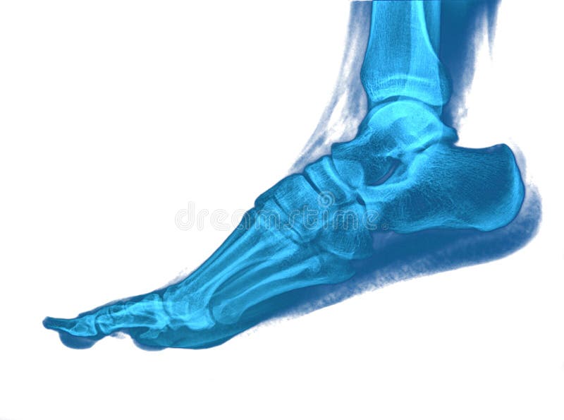 Foot Xray Showing Soft Tissue Gas in Patient with Necrotizing