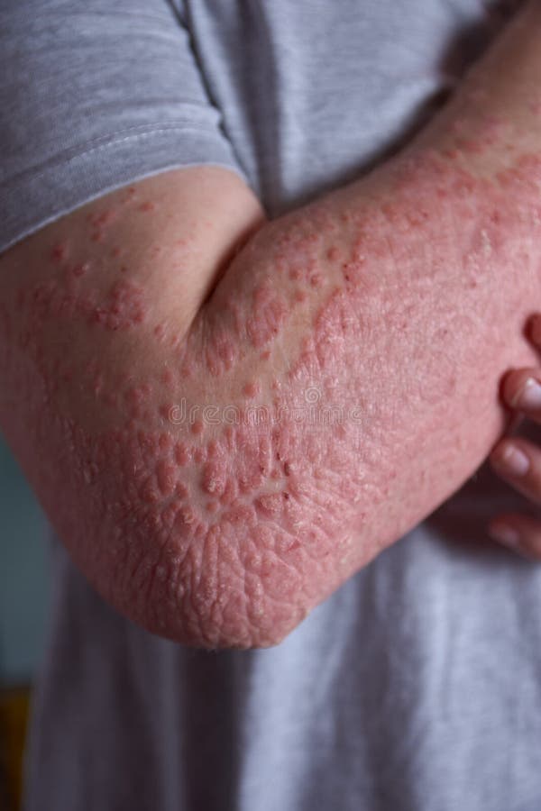 Forearm View With Psoriasis Stock Image Image Of Peptide Disease