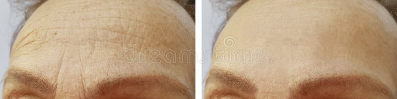 Forehead women wrinkles before and after procedures