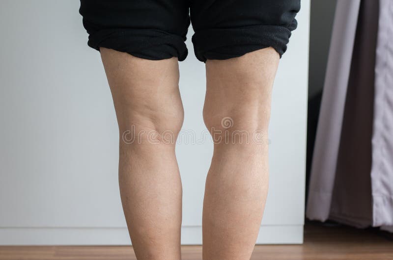 Forma con le gambe arcuate della gamba anziana asiatica della donna del corpo immagine stock libera da diritti Forma con le gambe arcuate della gamba anziana asiatica della donna del corpo immagine stock libera da diritti