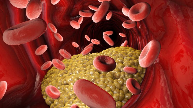 Cholesterol formation, fat, artery, vein, heart. Red blood cells, blood flow. Narrowing of a vein for fat formation, 3d render. Cholesterol formation, fat, artery, vein, heart. Red blood cells, blood flow. Narrowing of a vein for fat formation, 3d render