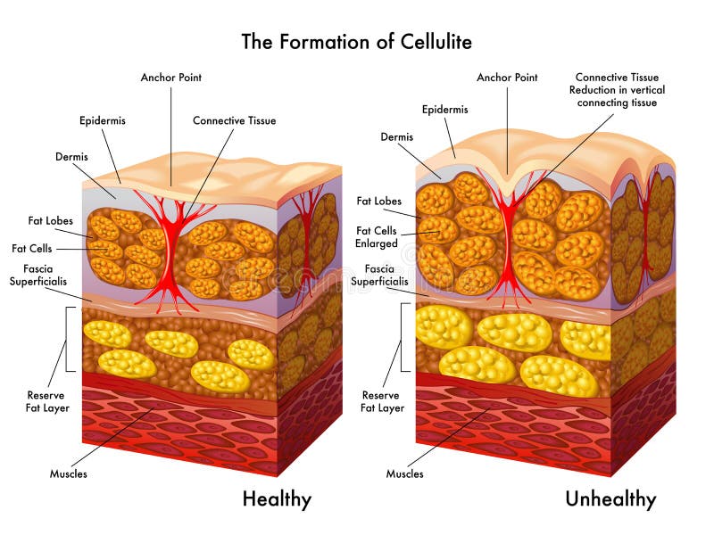 cellulite resistente