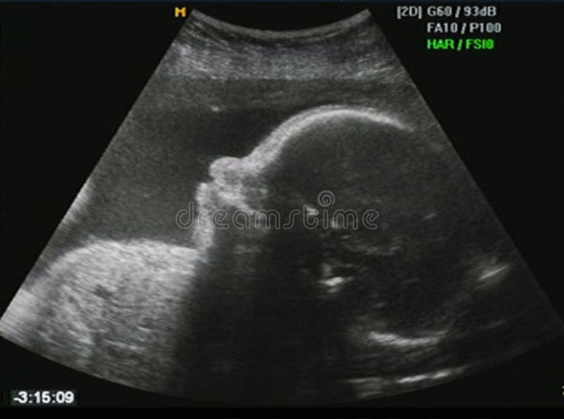 fosterultrasound fosterultrasound