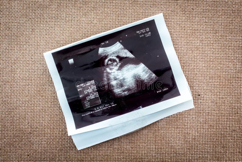 Foto de un sonogram del ultrasonido del bebé nonato imagen de archivo Foto de un sonogram del ultrasonido del bebé nonato imagen de archivo