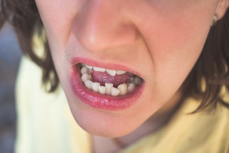 Foto dei denti curvati della donna