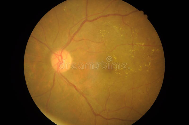 Foto medica di patologia retinica, disordini dello sclera, cornea, cataratta fotografie stock libere da diritti Foto medica di patologia retinica, disordini dello sclera, cornea, cataratta fotografie stock libere da diritti