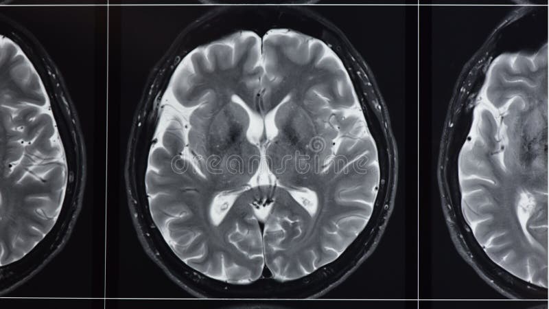 Fotografia di imaging a risonanza magnetica pesato T2 del cervello normale fotografia stock Fotografia di imaging a risonanza magnetica pesato T2 del cervello normale fotografia stock