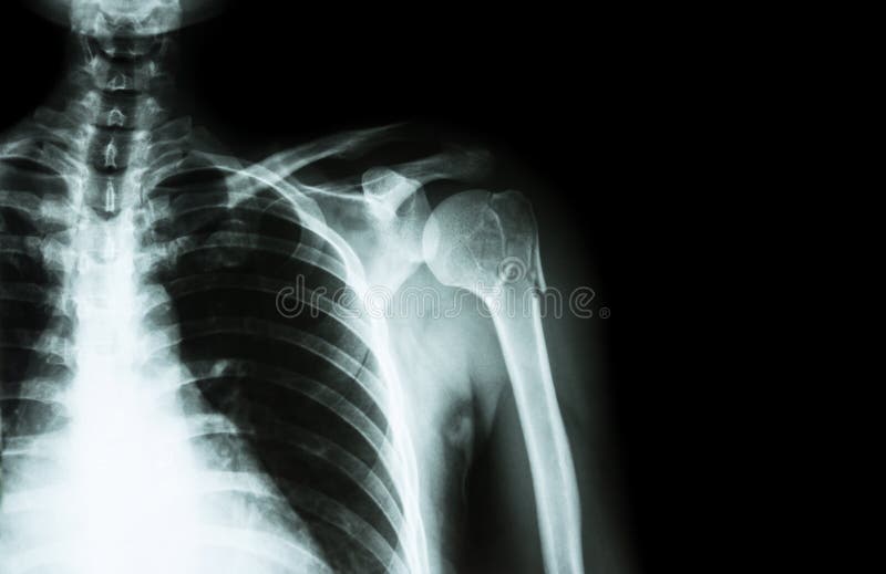Fracture au cou de l'humérus (os de bras) (épaule laissée par rayon X de film et secteur vide au côté droit) photo stock Fracture au cou de l'humérus (os de bras) (épaule laissée par rayon X de film et secteur vide au côté droit) photo stock