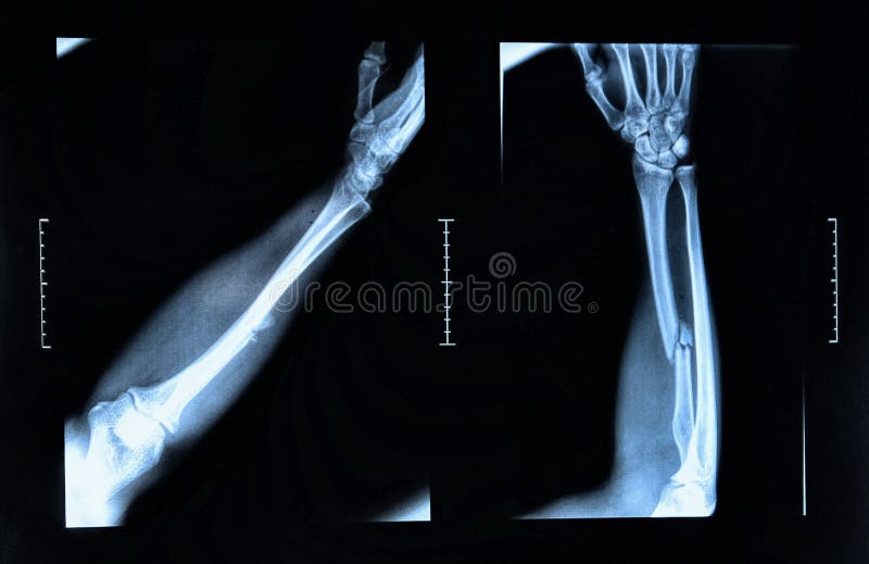 Fracture De Bras Vue Sur Le Rayon X Photo stock Image du diagnostic