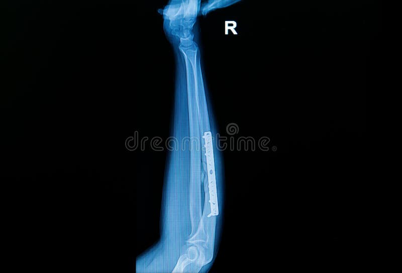 Forearm Orthopedic Implant Xray Scan Stock Image Image Of Replacement