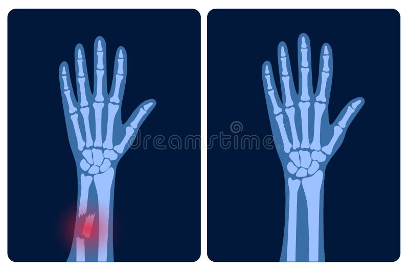 comminuted fracture hand comminuted fracture hand