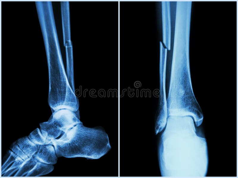 Fracture shaft of fibula bone ( leg bone ). X-ray of leg ( 2 position : side and front view stock photography