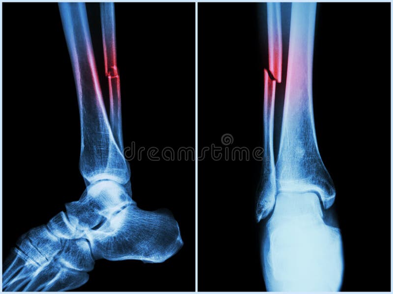 Fracture shaft of fibula bone ( leg bone ). X-ray of leg ( 2 position : side and front view ) stock images