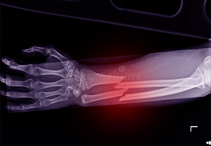Fracture Shaft Of Radius & Ulnar Bone Stock Photo Image of crash
