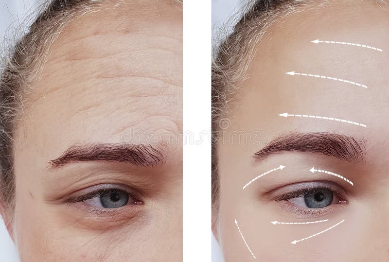 Framsidaskrynklor för efter cosmetologyskillnaden som lyfter tålmodig tillvägagångssättpilbehandling royaltyfri bild Framsidaskrynklor för efter cosmetologyskillnaden som lyfter tålmodig tillvägagångssättpilbehandling royaltyfri bild