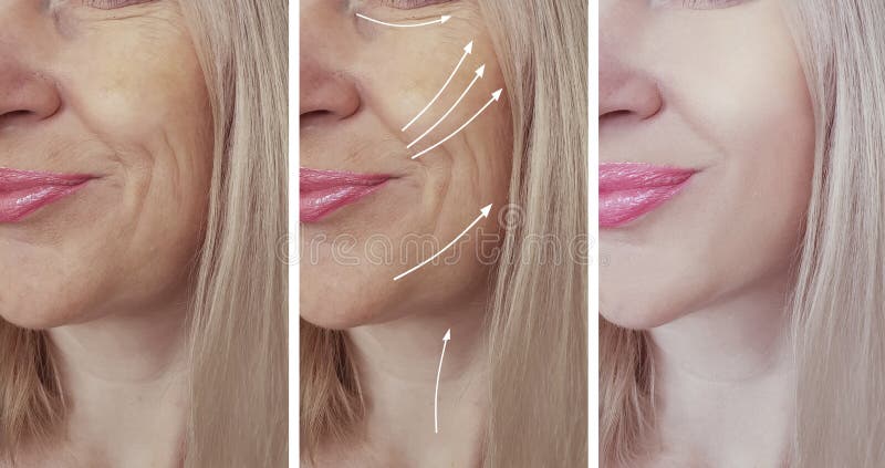 Frauenfalten stellen vor und nach Behandlungscollage gegenüber stockfotos Frauenfalten stellen vor und nach Behandlungscollage gegenüber stockfotos