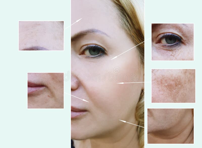 Frauengesicht knittert vor und nach Alternverfahren, Pigmentationsdermatologie stockbilder Frauengesicht knittert vor und nach Alternverfahren, Pigmentationsdermatologie stockbilder