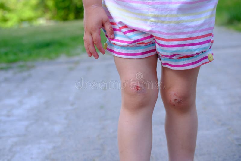 Fresh Wound Bleeding Abrasion On Knees Of Girl Child Fell On Walk