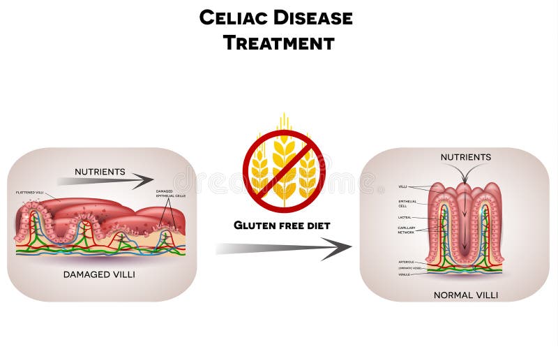 Fri behandlinggluten för den Celiac sjukdomen bantar