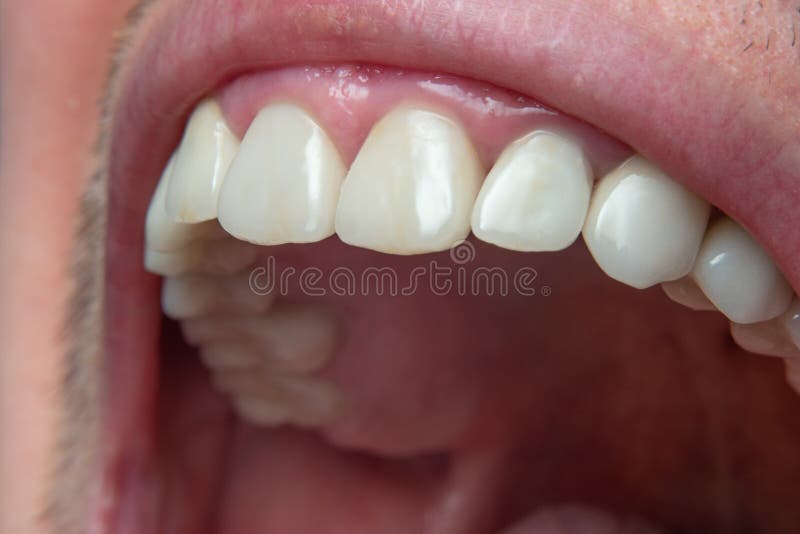 Caucasian male opened mouth close up macro shot. Row of with teeth, visible oral cavity, unrecognizable face. Caucasian male opened mouth close up macro shot. Row of with teeth, visible oral cavity, unrecognizable face.