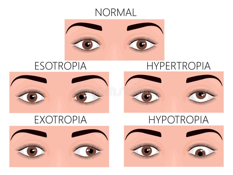 Front_Strabismus de la cara u ojos cruzados libre illustration Front_Strabismus de la cara u ojos cruzados libre illustration