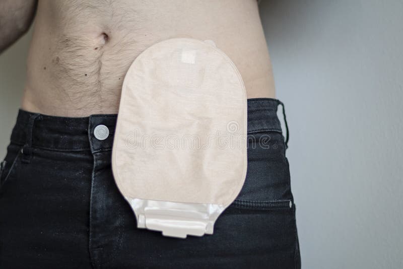 front-view-colostomy-bag-attached-to-man-patient-medical-theme-skin-color-ostomy-pouch-close-up-front-view-colostomy-bag-167873916.jpg