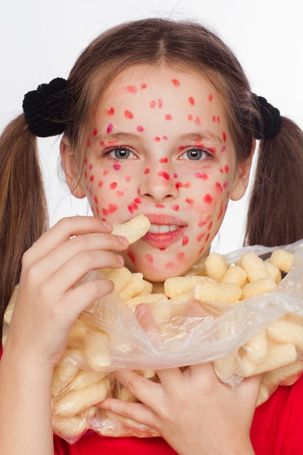 Front View of a Girl with a Problem Skin Rash Who Eats Corn Sticks